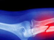 Microplastics Could Be Weakening Your Bones, Research Suggests